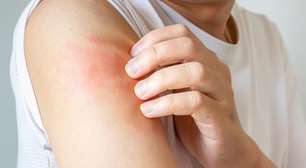 Calor e umidade aumentam casos de micoses no verão