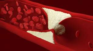 Como a cebola ajuda a reduzir a aterosclerose e proteger o coração