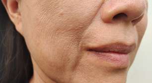 Nutricionista comenta os alimentos que podem deixar sua pele mais flácida