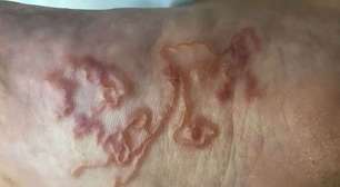 Bicho-geográfico: cuidados essenciais para a prevenção