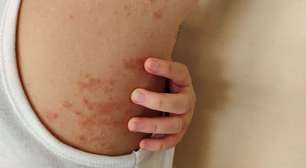 Hanseníase: Brasil é o 2º no mundo em casos da doença