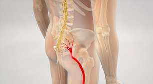 Dor no ciático: saiba o que causa e como tratar o problema