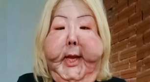 Juju do Pix exibe resultados 50 dias após cirurgia para retirada de óleo do rosto