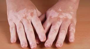 Vitiligo: causas, sintomas e como tratar as manchas na pele