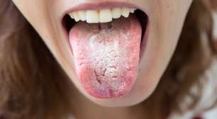 Saburra lingual: veja o que deixa a língua branca