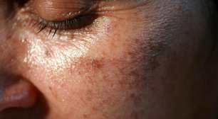 Manchas na pele após as férias: como tratar