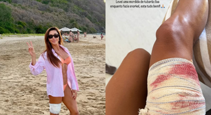 Advogada é mordida por tubarão durante mergulho em Noronha e brinca: 'Deve estar sem dente'