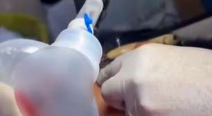 Criança de 10 anos fica com anzol preso na bochecha durante pescaria em Goiás