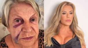 Poliana passa por susto após queda da mãe, que aparece com olho roxo