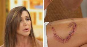 'Ainda bem que foi comigo, tinha crianças ali', diz mulher mordida por tubarão em Noronha