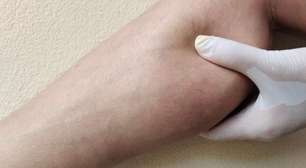 Lipedema ou linfedema? Saiba identificar e quando procurar ajuda