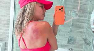 Tenista mostra queimaduras de sol: como cuidar da pele