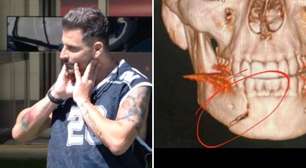 BBB26: Sequela de Henri Castelli pode ter causado convulsão na Prova do Líder