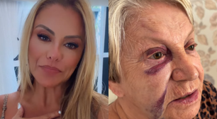 Mãe de Poliana Rocha, aos 84 anos, sofre acidente e fica com hematomas no rosto
