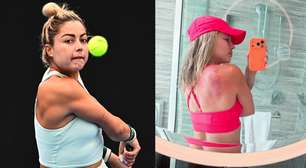 Tenista mexicana expõe queimaduras de sol após torneio na Austrália