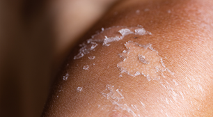 Pele descascando após o banho de sol? Saiba como evitar e tratar corretamente
