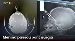 Criança de 1 ano fica com carregador cravado na testa após cair da cama em MG