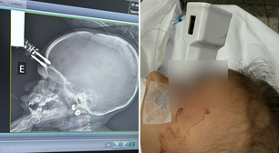 Criança de 1 ano cai da cama e fica com carregador cravado na testa em MG; veja fotos