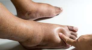 Inchaço do nada: 6 motivos que quase ninguém liga