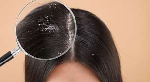 Caspa ou psoríase? Veja como identificar no couro cabeludo