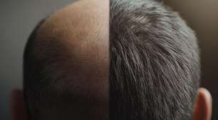 Demanda por transplante capilar valoriza resultados naturais