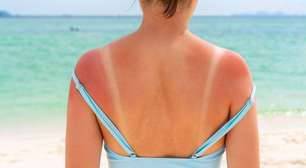 Babosa funciona pra queimadura de sol? Veja o jeito certo