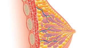 Entenda o câncer de mama triplo-negativo, o de Roseana Sarney