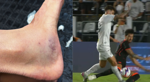 Zagueiro do Corinthians revela ferimento e ironiza decisão da arbitragem em duelo contra o Santos