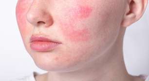 Estado emocional pode causar manchas vermelhas na pele; entenda