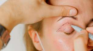 Blefaroplastia: entenda detalhes da cirurgia feita por Leonardo