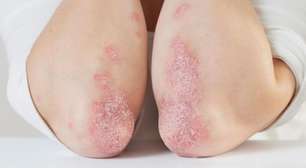 Sem preconceito: veja mitos e verdades sobre a hanseníase