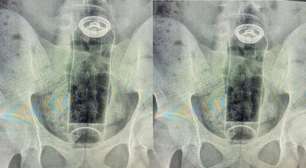 Jovem de 19 anos é internado após objeto ficar preso no ânus