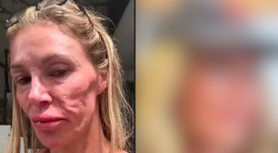 UAU! Influenciadora que teve rosto 'derretido' mostra como está após várias cirurgias