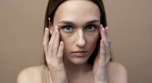 De pigmentação à flacidez: o que realmente causa olheiras