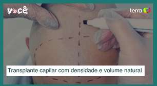 Transplante capilar com densidade e volume natural: conheça o método DVN
