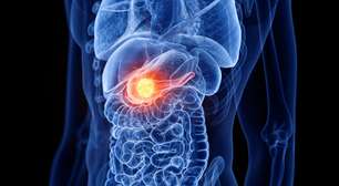 Pesquisadores conseguem eliminar câncer de pâncreas com combinação tripla de remédios