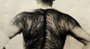 Síndrome do homem lobo: fatos e curiosidades sobre a hipertricose