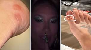 Virginia mostra série de lesões após ensaio da Grande Rio: 'Descobri machucado que nem sabia'