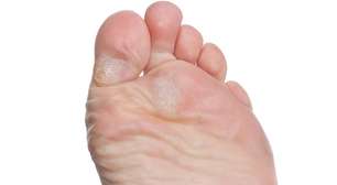 Calo no pé: por que aparece, como tratar com segurança e o que fazer para evitar o problema
