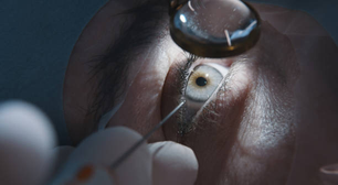 Cirurgia de catarata em ambos os olhos no mesmo dia é considerada segura e eficaz