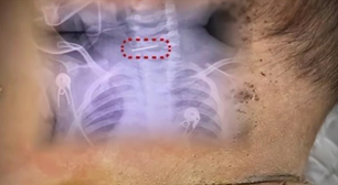 Mãe fura bebê mais de 600 vezes por 'mau comportamento' e agulha acaba presa na coluna cervical