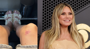 Heidi Klum posta foto de machucados após usar roupa moldada no Grammy 2026