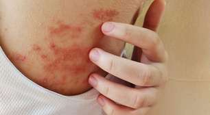 Cicatrizes da Alma: Quando trauma psicológico vira dermatite