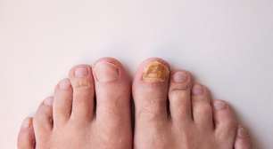 O que suas unhas estão tentando dizer sobre sua saúde?