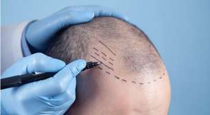 Calvície: conheça os tratamentos mais modernos dos consultórios