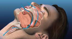 Dispositivos anti-ronco: como funcionam e qual é mais eficaz
