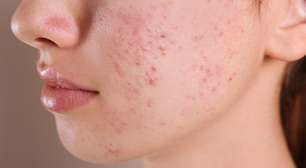 Acne hormonal: por que sua pele piora em certas épocas do mês?