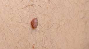 O que são sinais no corpo e por que aparecem ao longo da vida