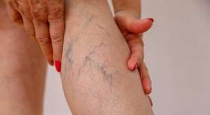Obesidade e varizes têm relação e exigem atenção médica