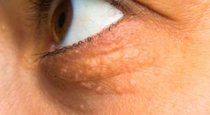 Xantelasmas: as manchas amareladas nos olhos podem indicar risco de infarto?
